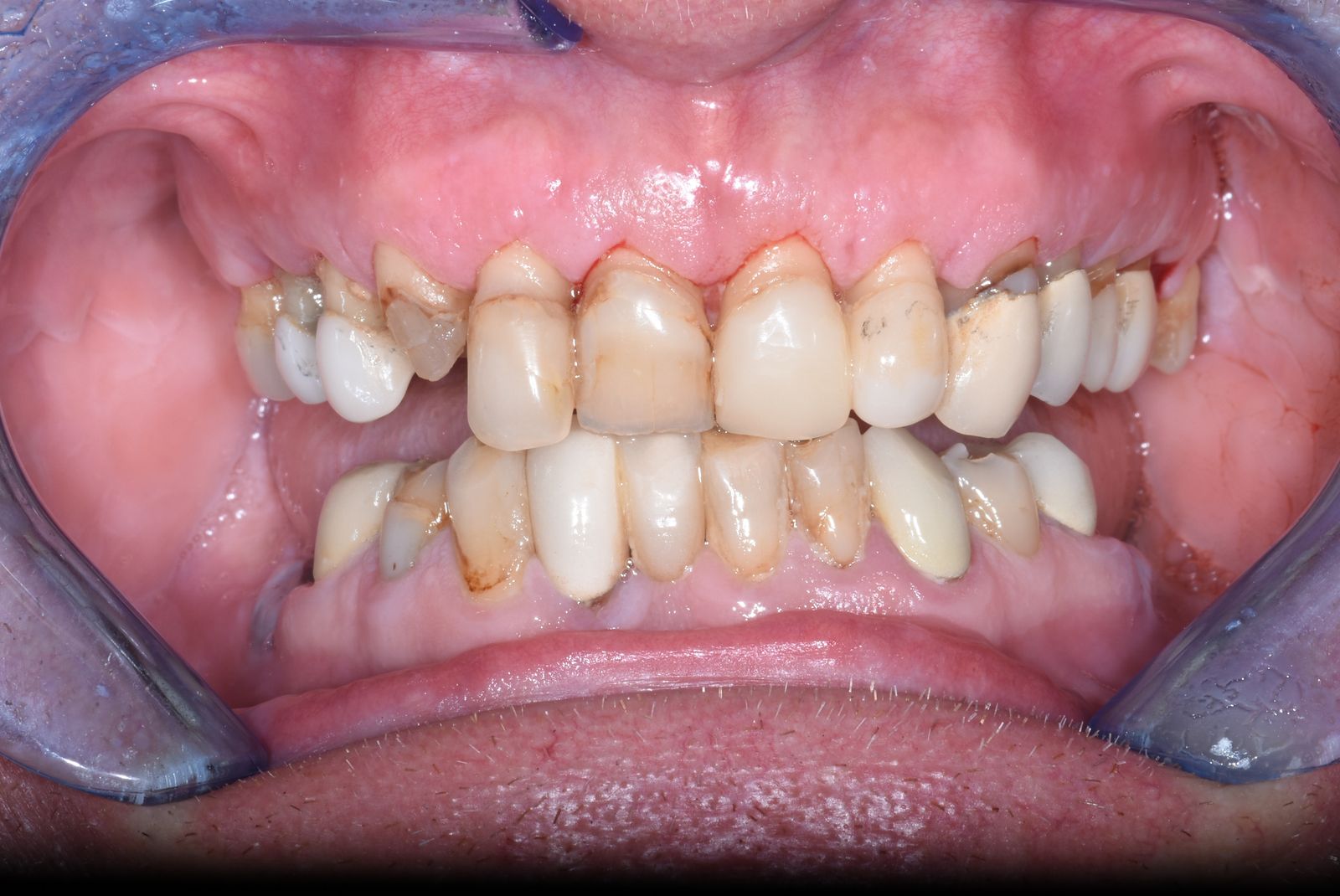 Patient T before treatment