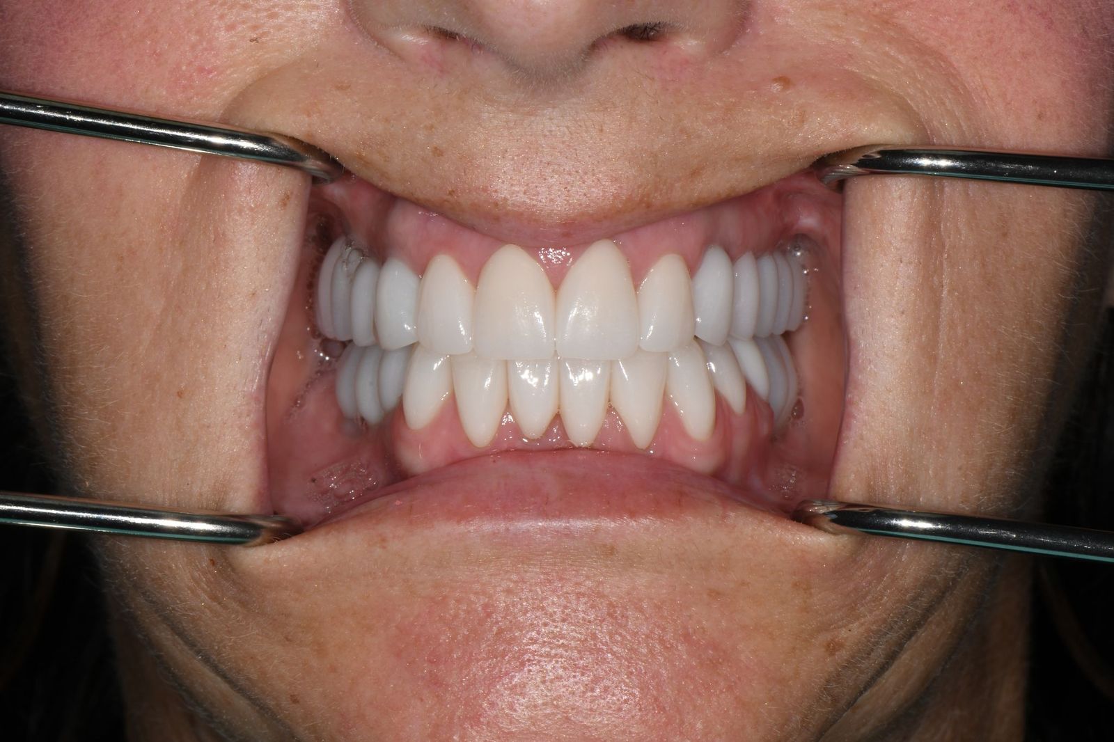Patient J after treatment