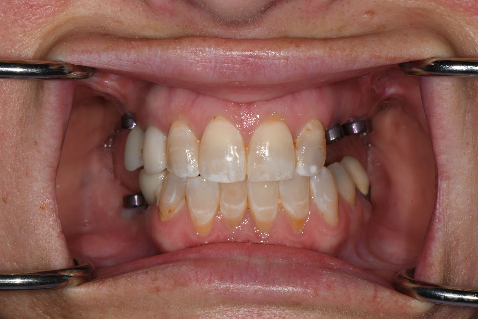 Patient J before treatment