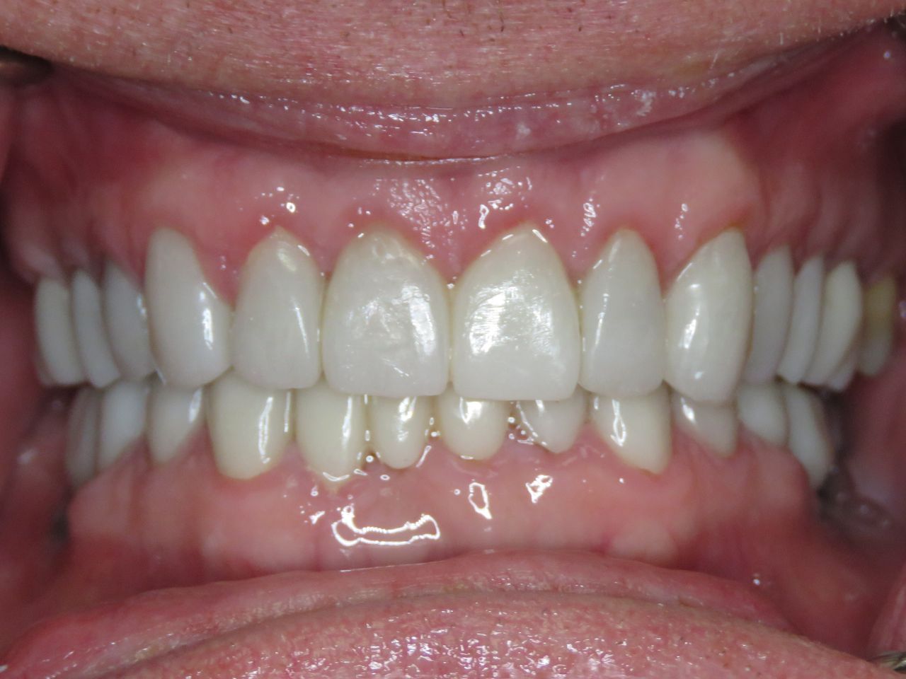 Patient T after treatment