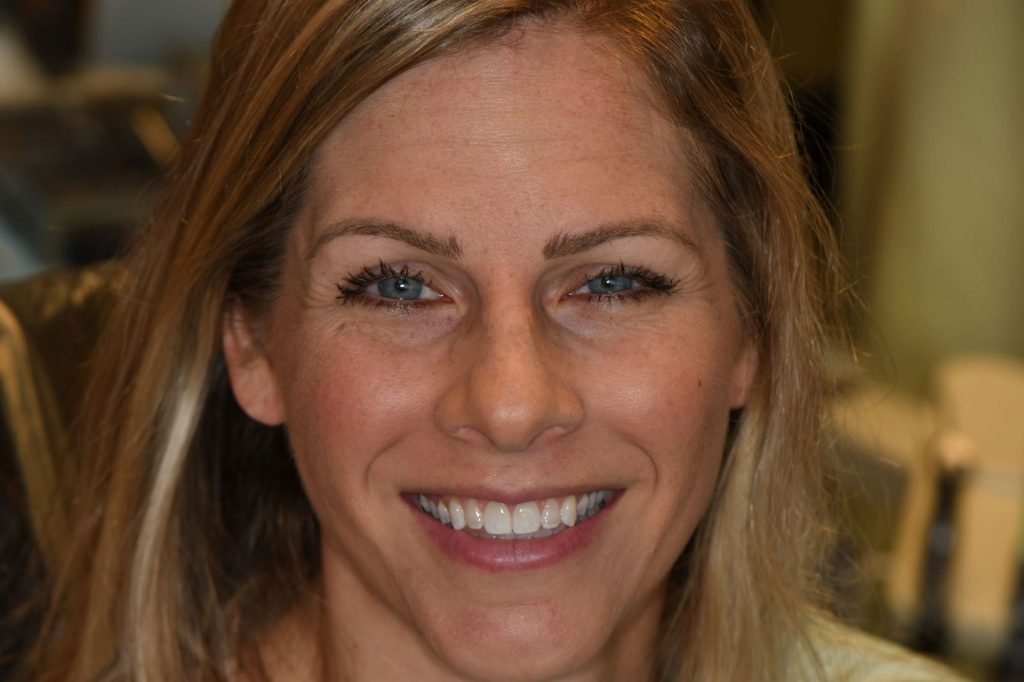 Patient J smile after treatment