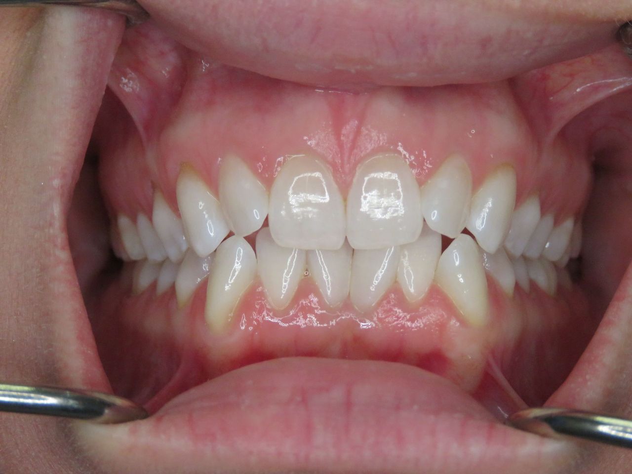 Patient V before treatment