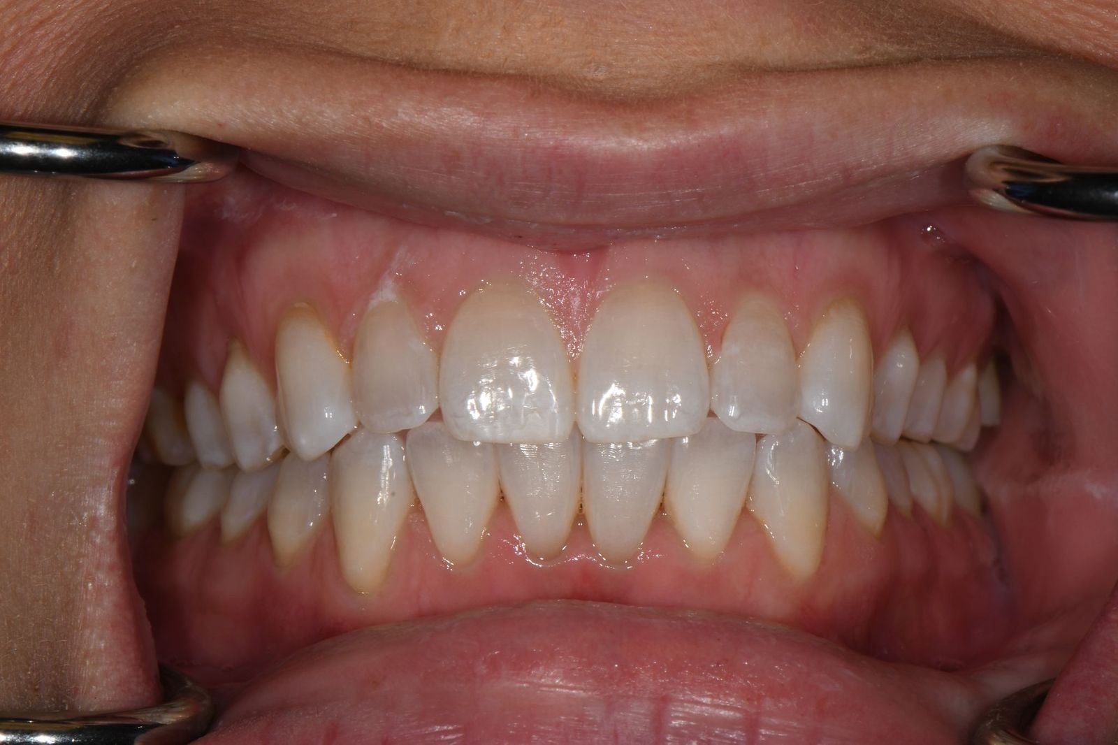 Patient V after treatment
